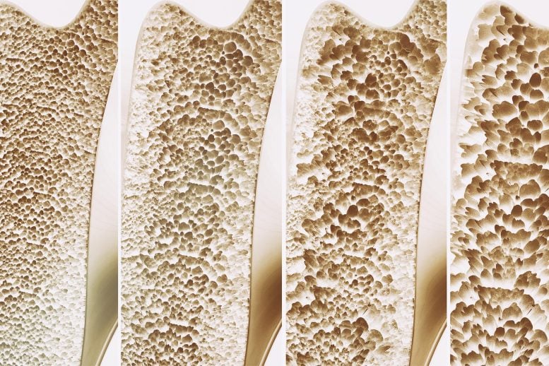 Bone Strength Osteoporosis Stages