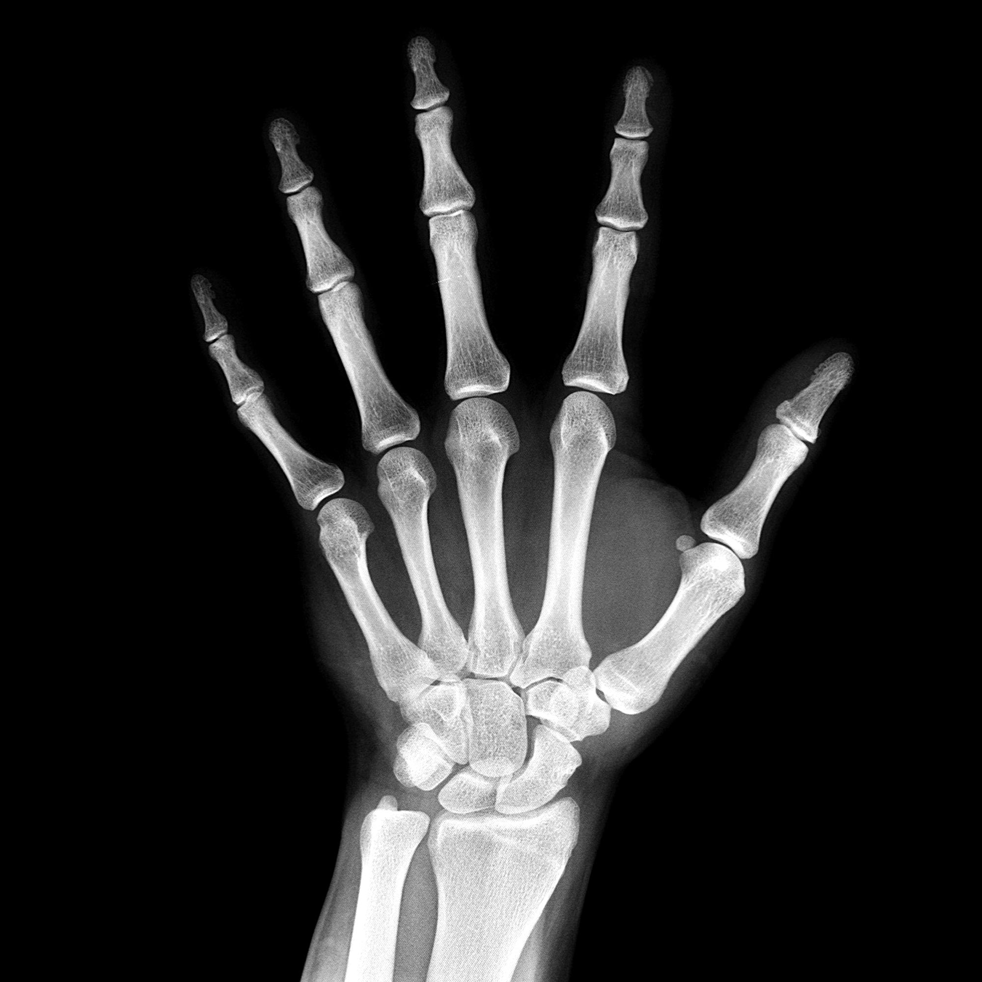 Bones X-Ray