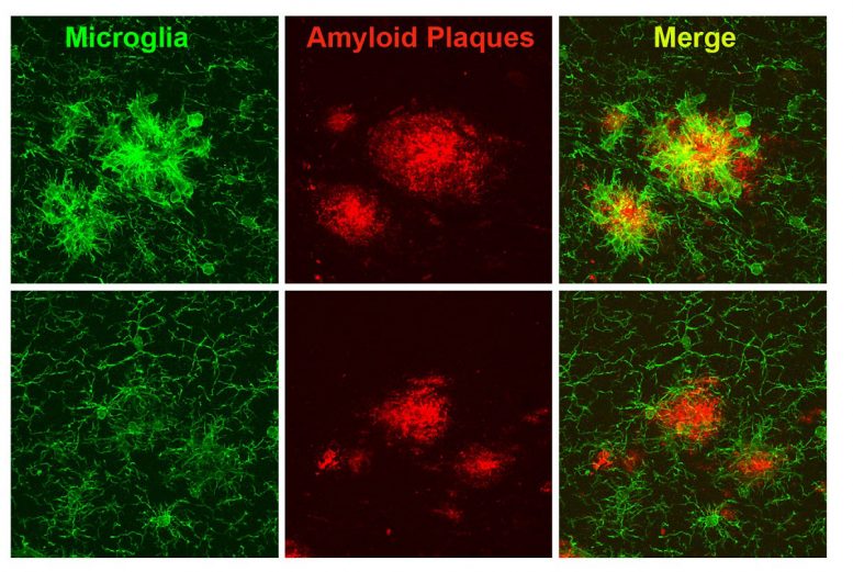 Boosting Brain’s Immune Cell Function Improves Alzheimer’s Symptoms