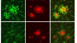 Boosting Brain’s Immune Cell Function Improves Alzheimer’s Symptoms