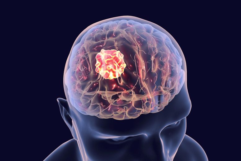 Brain Cancer 3D Tumor