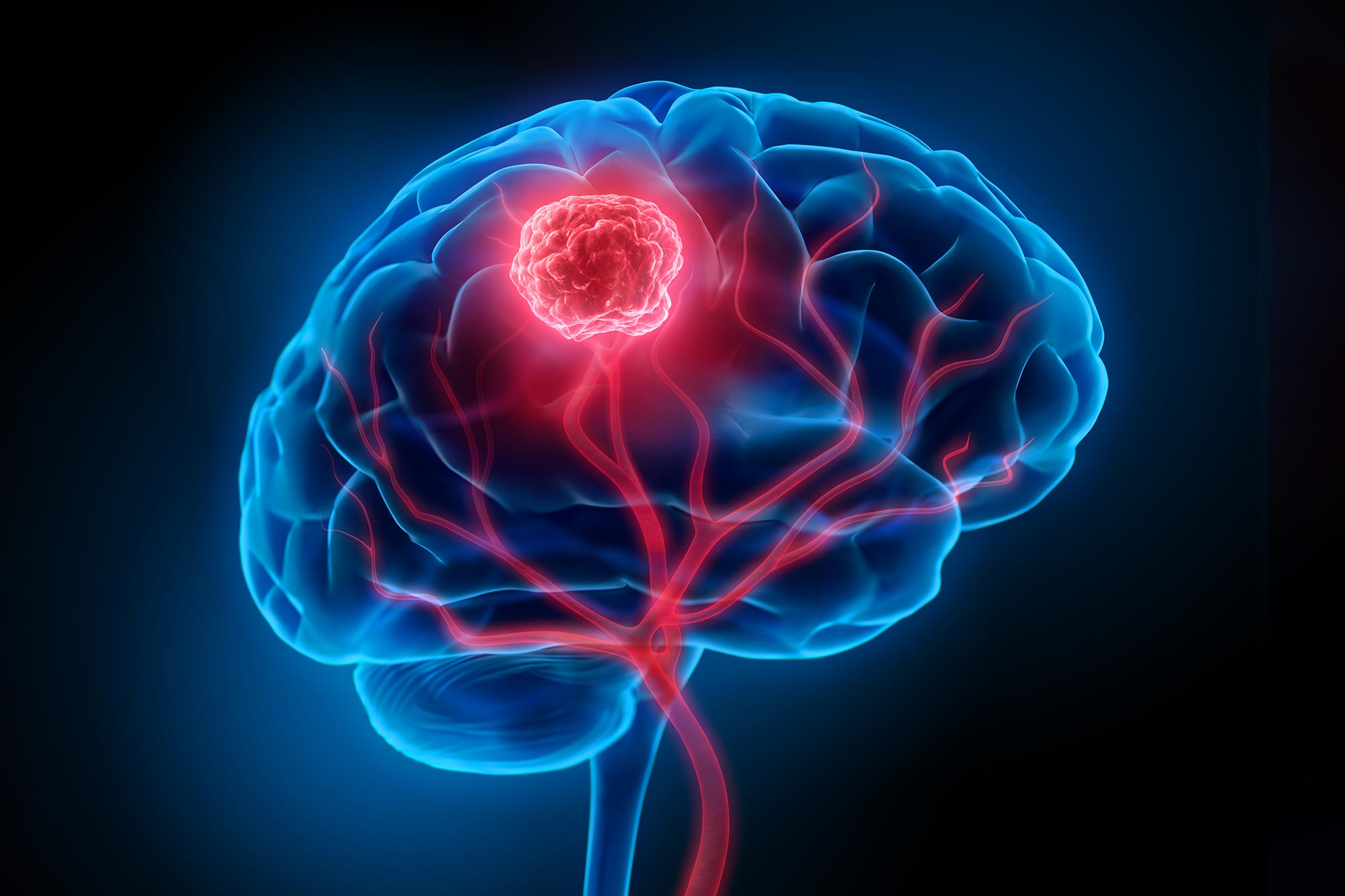 Could a Simple Nasal Drop Treat the Deadliest Brain Cancer?