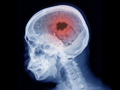 Research Breakthrough Could Mean Better Treatment for Most Deadly Form ...
