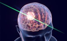 Brain Cancer Laser Treatment