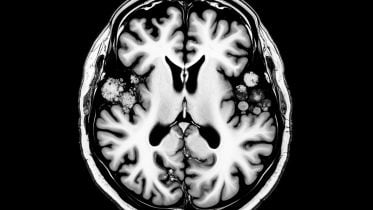 Brain Disease Scan Neurological Disorder Art Concept