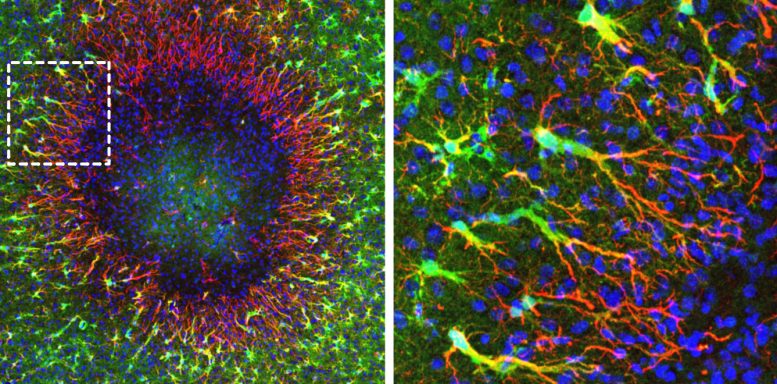 Brain Lesion With Regenerative Astrocytes
