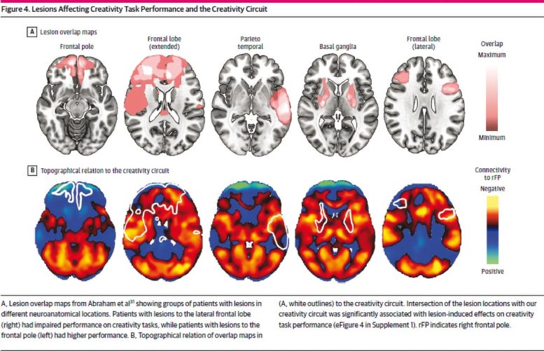 Brain Lesions Affecting Creativity Task Performance