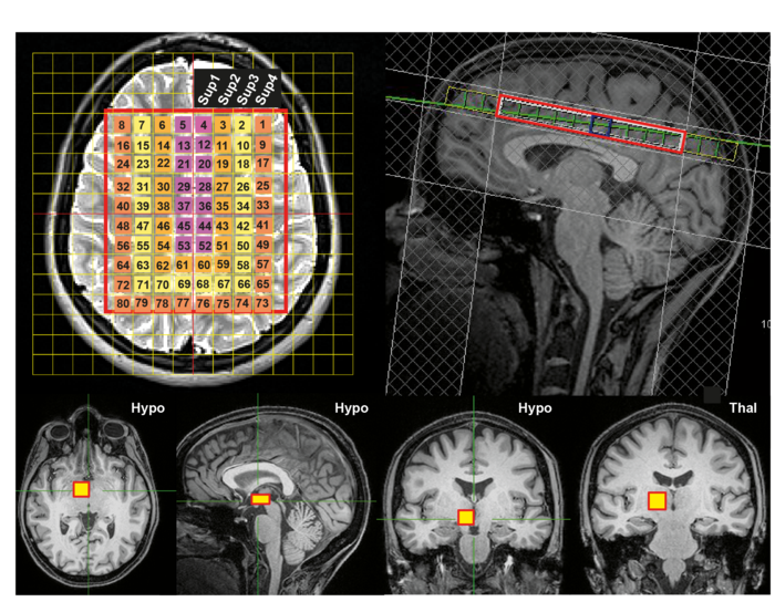 Brain Magnetic Resonance Spectroscopy