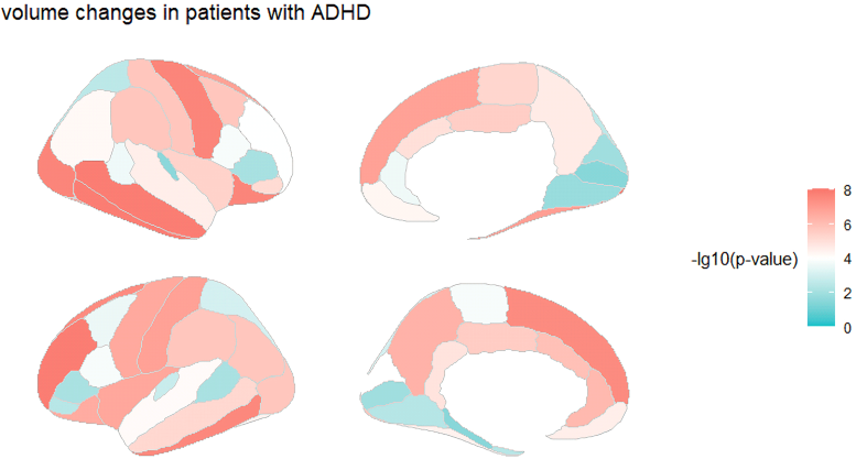 Brain Markers of ADHD in Children