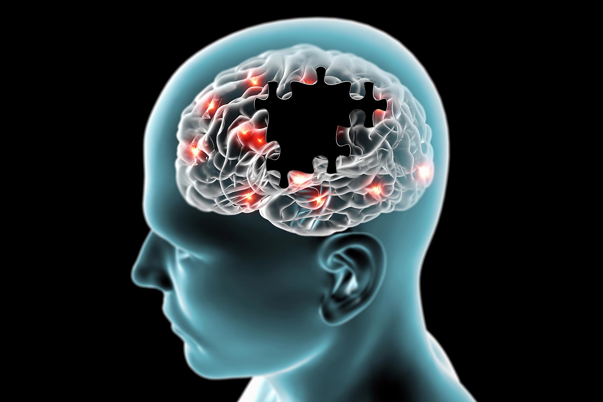 Alzheimer’s May Start With a Surprising Symptom - Not Memory Loss