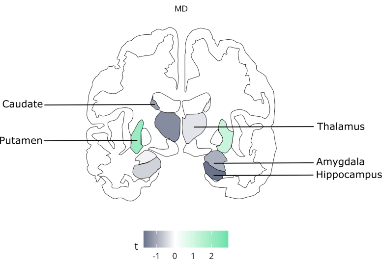 Brain Regions Associated With High Consumption of Ultra Processed Foods