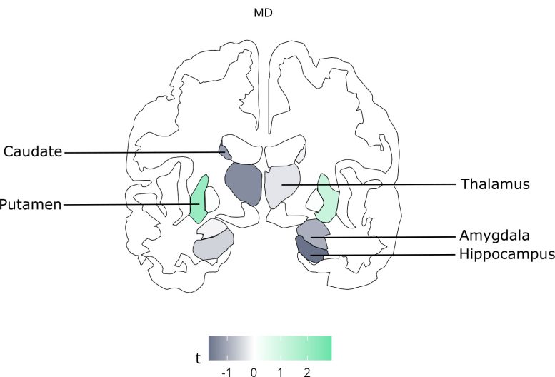 Brain Regions Associated with High Consumption of Ultra Processed Foods