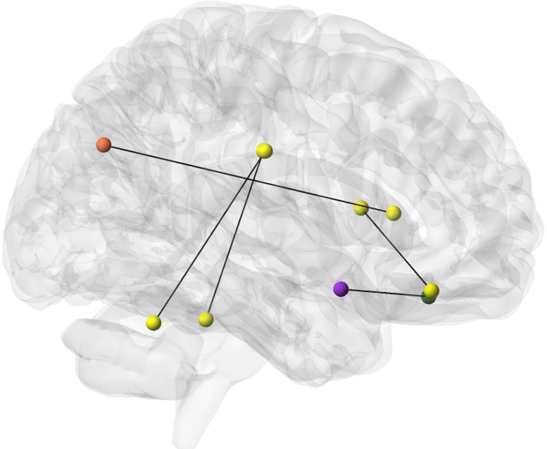Brain Regions Tied to Frailty