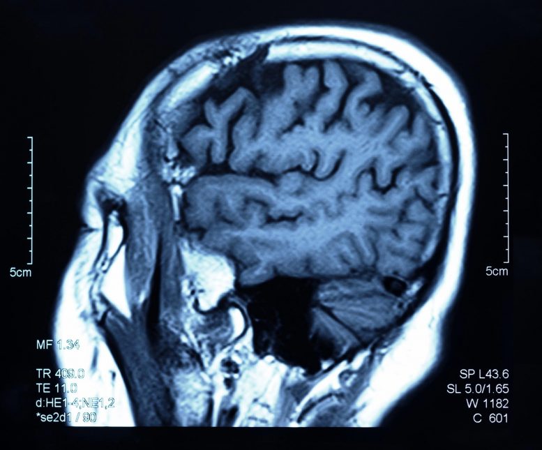 Brain Scan MRI Capture