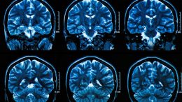 Brain Scan MRI Images