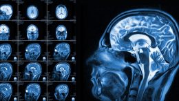 Brain Scan Reveals ADHD as a Collection of Different Disorders