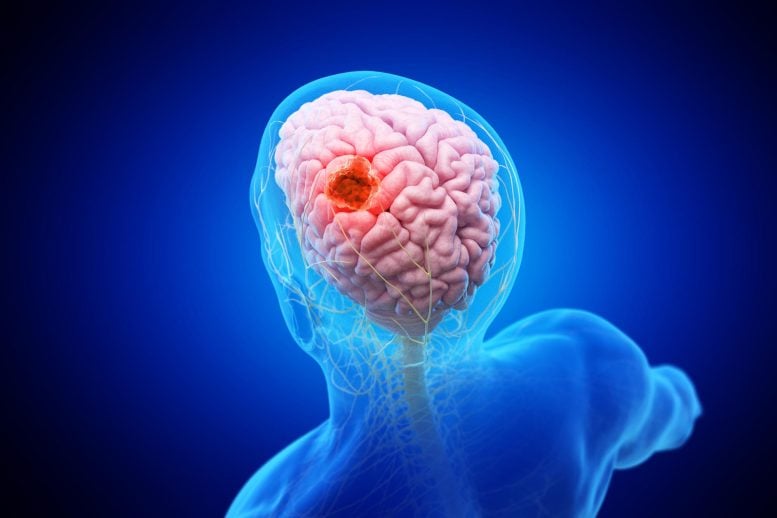 Brain Tumor Anatomy Cancer