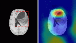 Brain Tumors Deep Learning Model