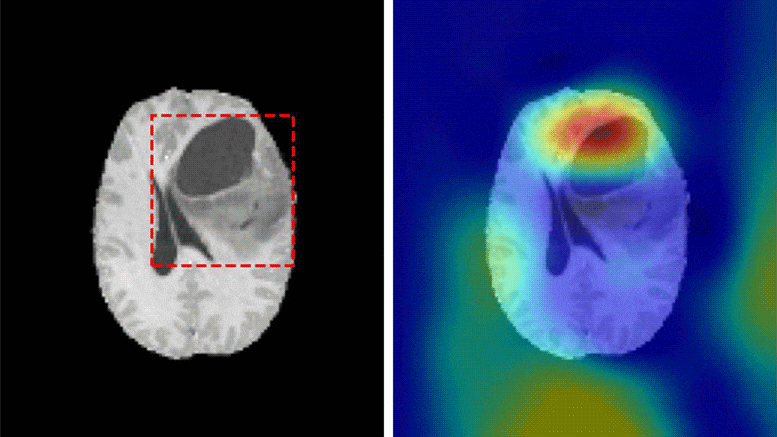 Artificial Intelligence Classifies Brain Tumors With Single Mri Scan