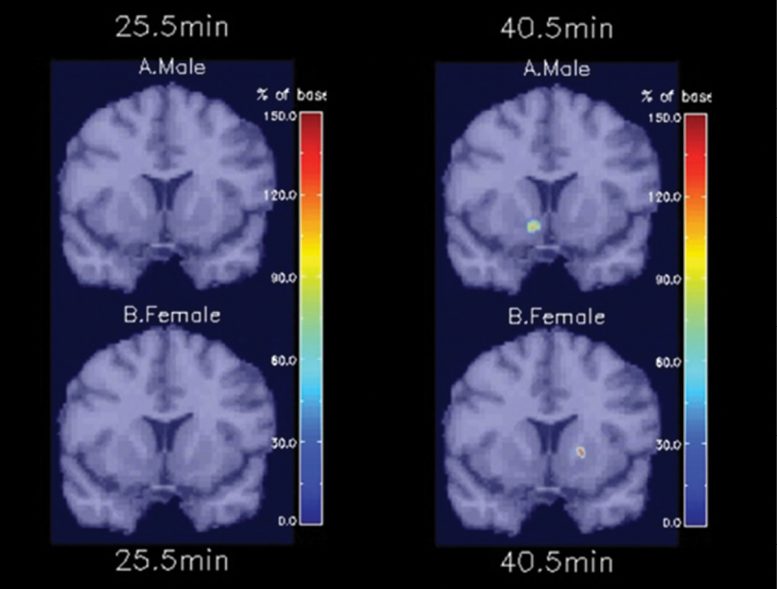 Brain’s Response to Smoking Is Different in Men and Women