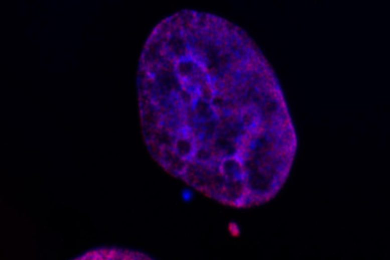 Breast Cancer Cell Micronuclei