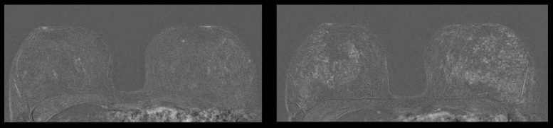 Breast MRI IUD