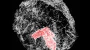 Breast Tumor Imaged in 3D