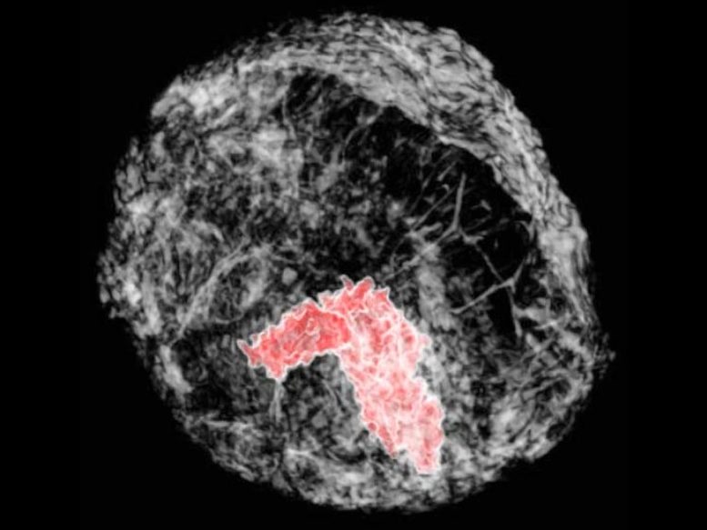 Breast Tumor Imaged in 3D