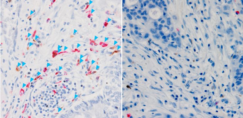 C3 Expression and Macrophages in Tumors