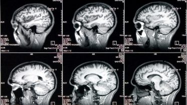 Five Different Diseases Attack Language Areas in Brain