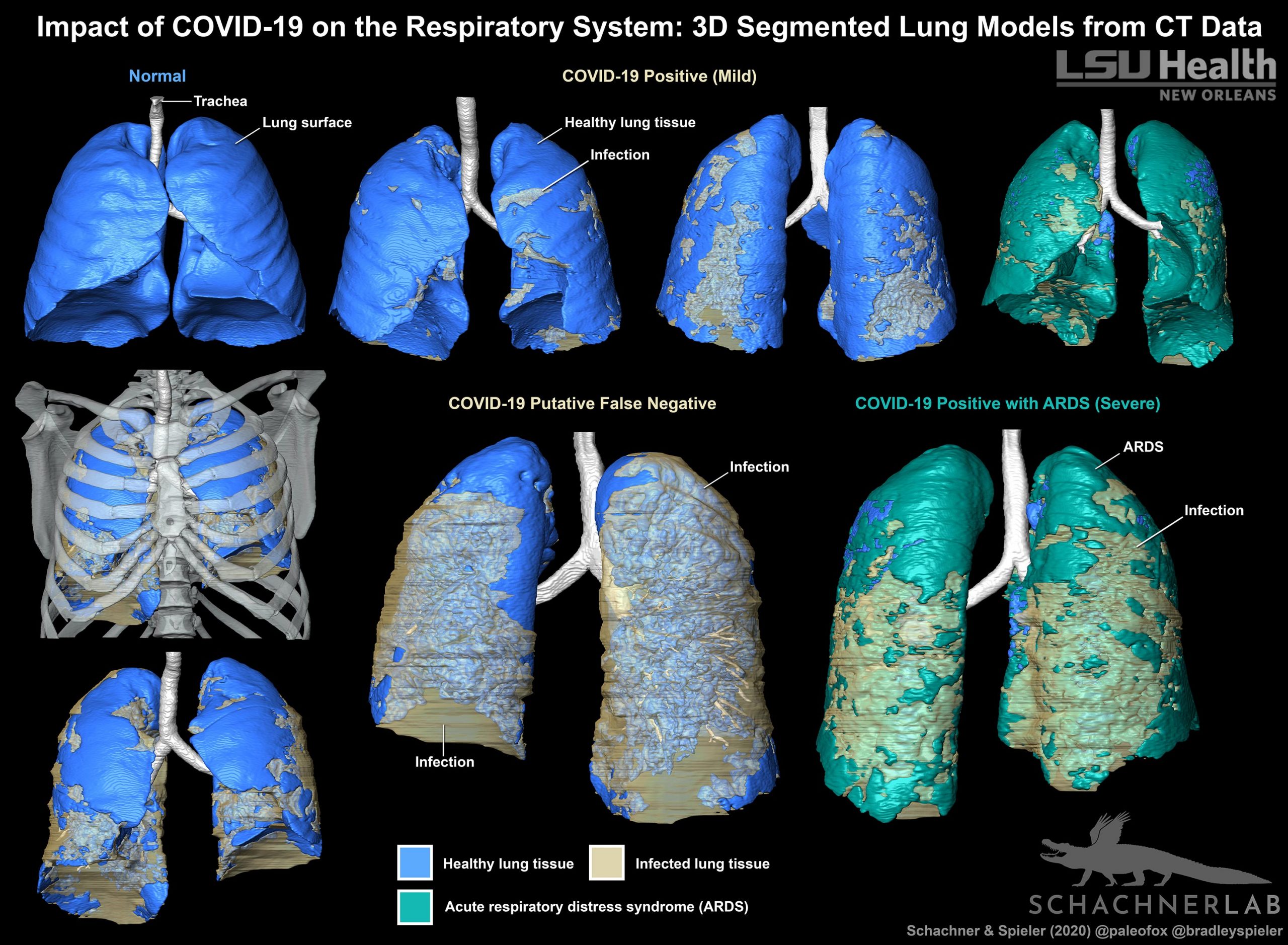 Better Tool Created To Aid Covid 19 Diagnosis