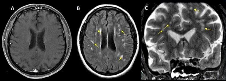 Escaneo cerebral COVID-19 de 49 mujeres