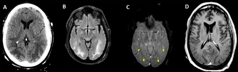 COVID-19 Brain Scan Cerebral Edema