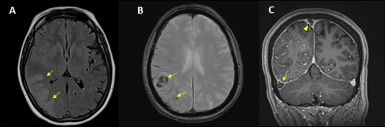 COVID-19 Brain Scan Hemorrhage