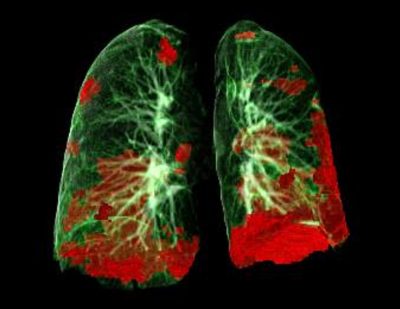 lung lungs suffer scan recover inflammation radiology heal trigger widmann yalibnan