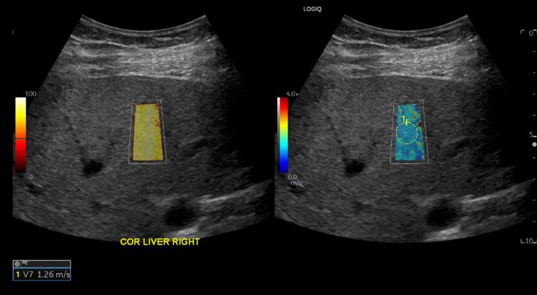 COVID-19 Patients Show Liver Injury Months After Infection Ultrasound