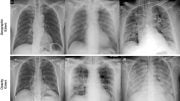 COVID Chest X-rays