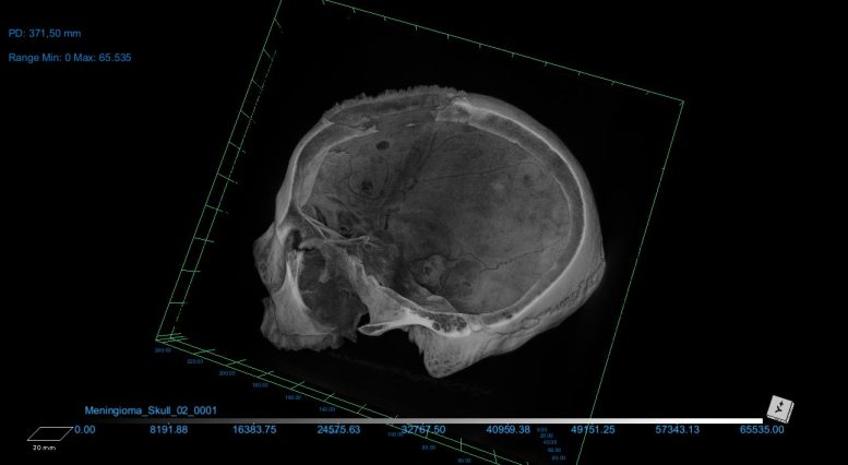 CT Scan of Skull E270