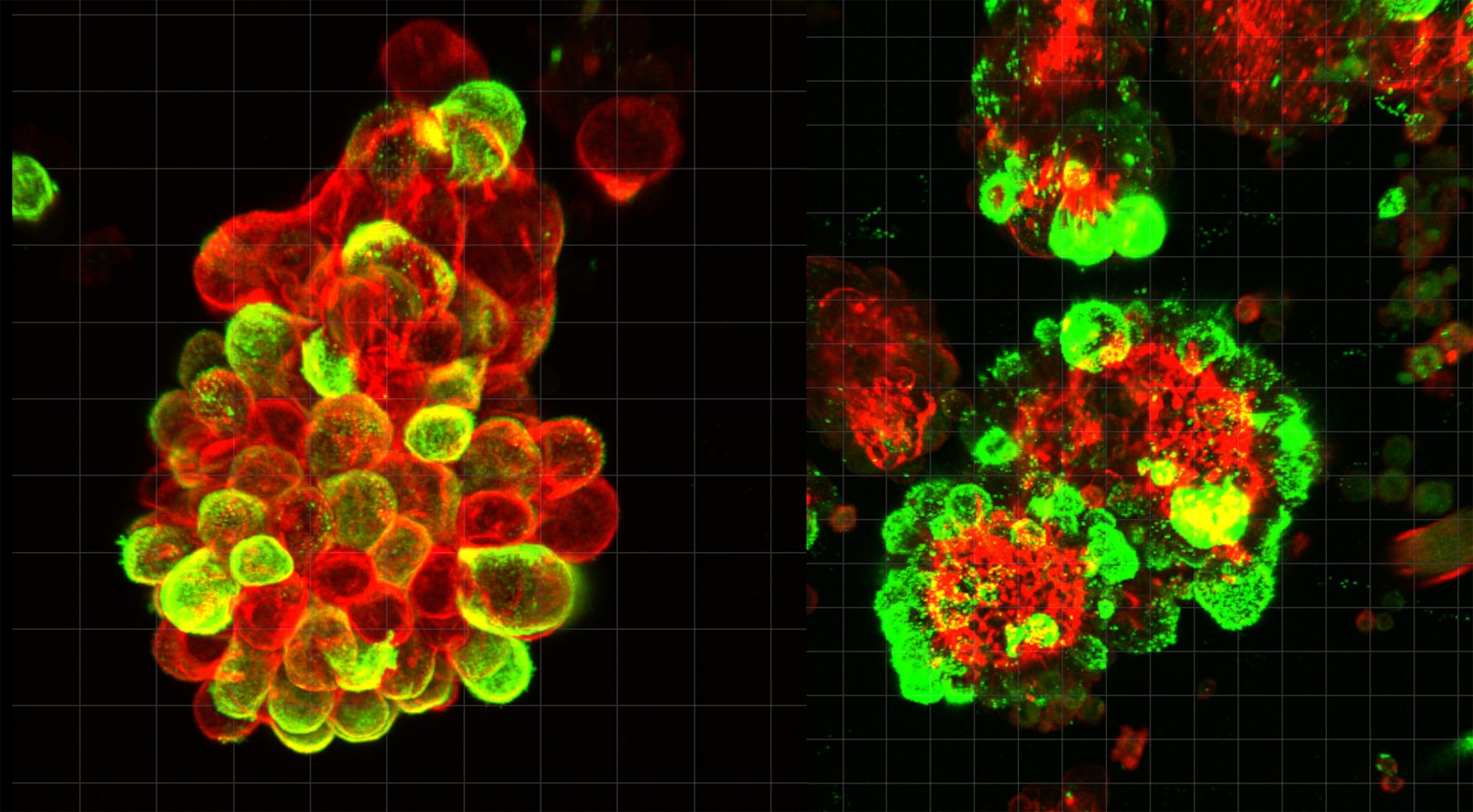 This Is How Ovarian Cancer Spreads Before Doctors Can Detect