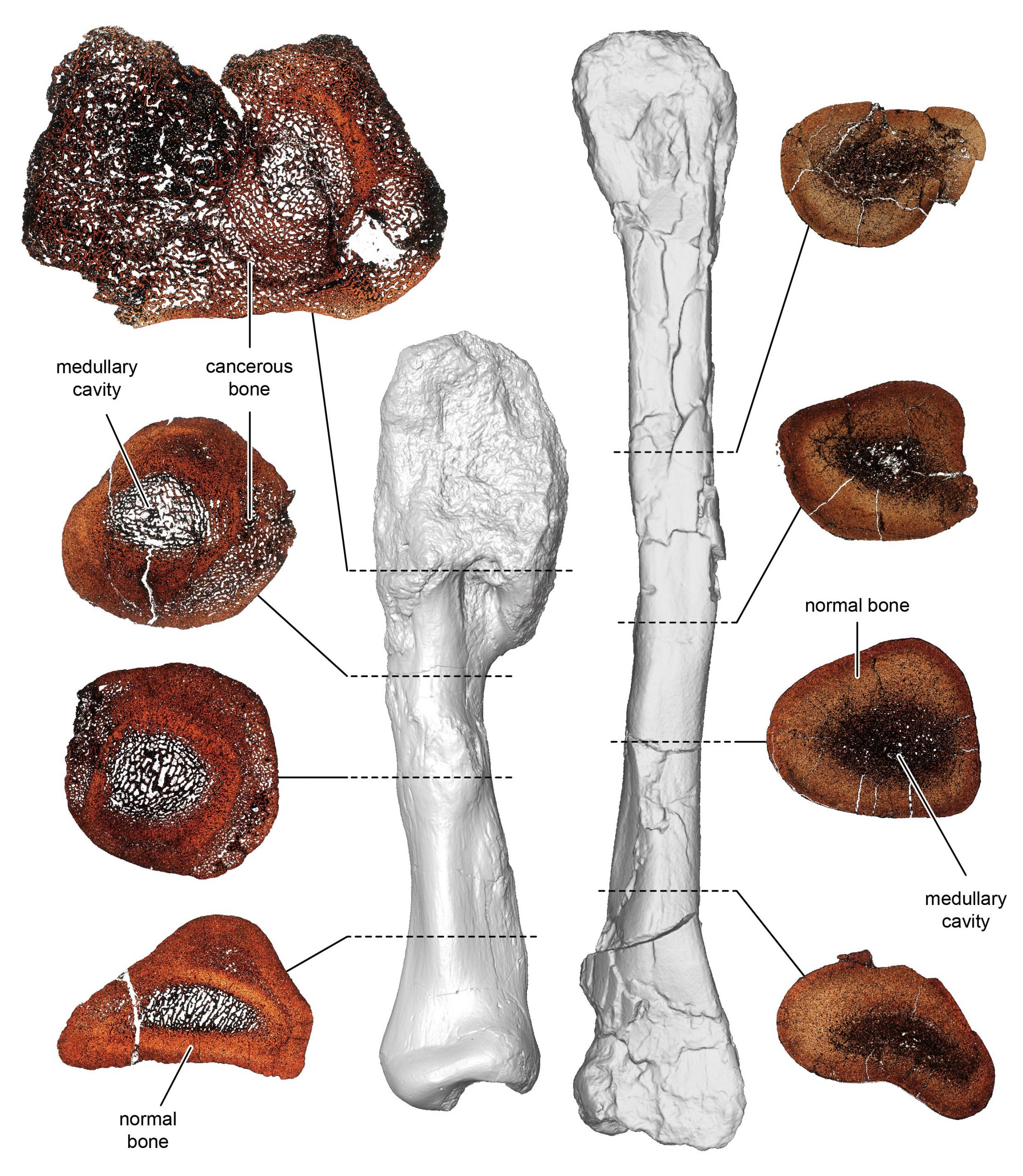 Dinosaur Diagnosed With Malignant Cancer for the First Time â€“ Cancerous Bone From 77 Million Years Ago - SciTechDaily
