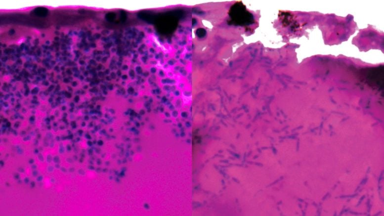 Deadly Hospital Fungus May Finally Have a Weakness