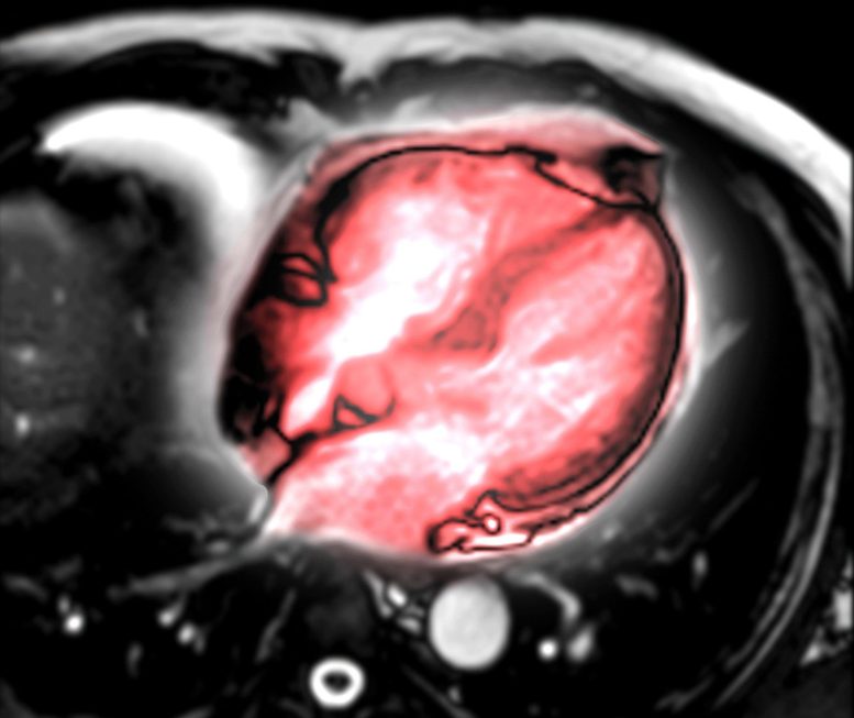 Cardiac Heart MRI Scan