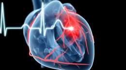 Cardiology Heart Attack Illustration