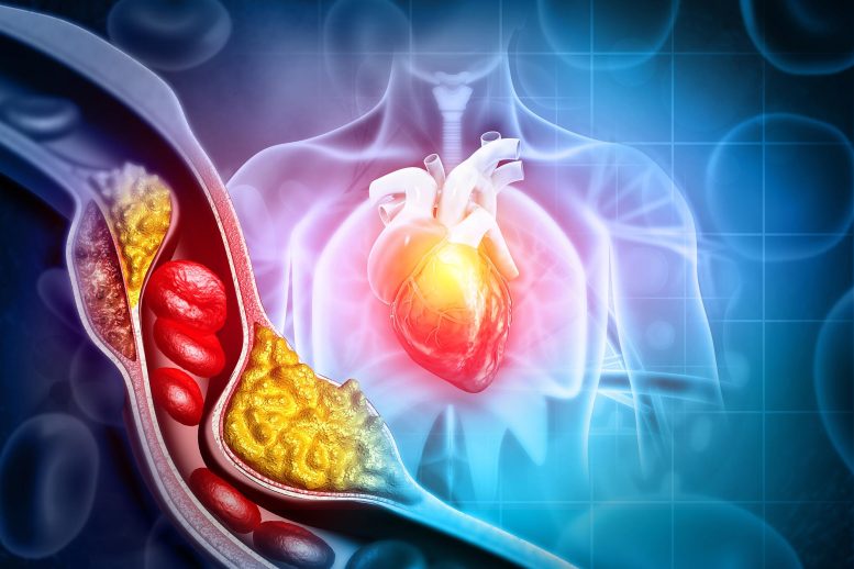Cardiology Heart Cholesterol Blocked Artery