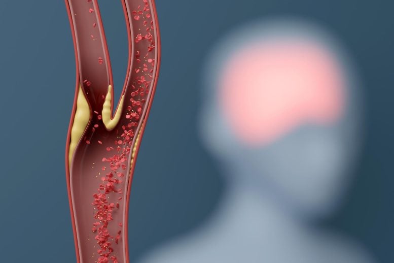 Carotid Artery Blocked Cholesterol Reduced Brain Blood Flow