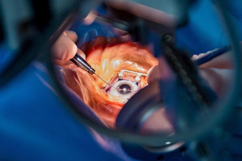 Cataract Surgery Eye Operation