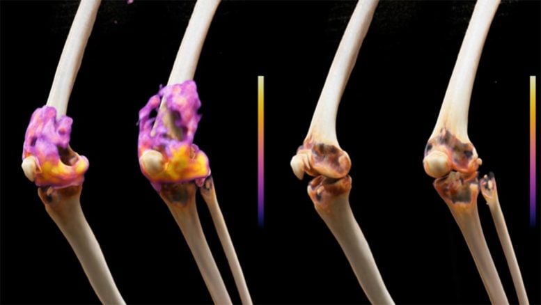 Cell Therapy Treats Severe Rheumatoid Arthritis