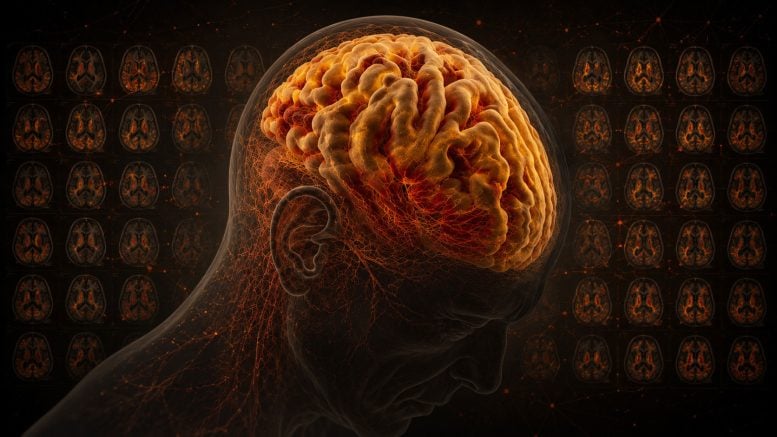 Centiloid Scale Alzheimer&rsquo;s Disease