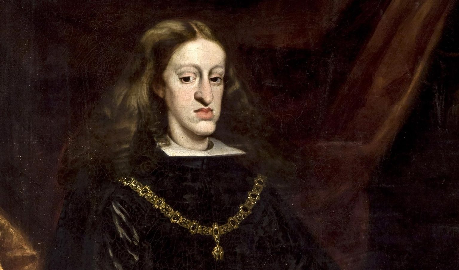 “Habsburg Jaw” Facial Deformity in Royal Dynasty Linked to Inbreeding