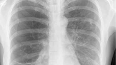 Chest X-Ray Smoker Lungs Emphysema